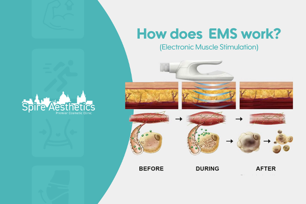 EMS treatment for post pregnancy weight loss treatment Wibsey
