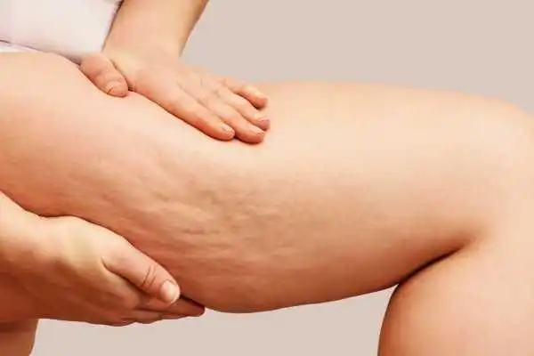 Image of woman showing leg with cellulite Wibsey