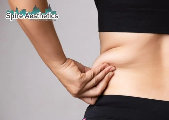 Image of woman pinching fat on their hips Wibsey. Fat Freezing treatment