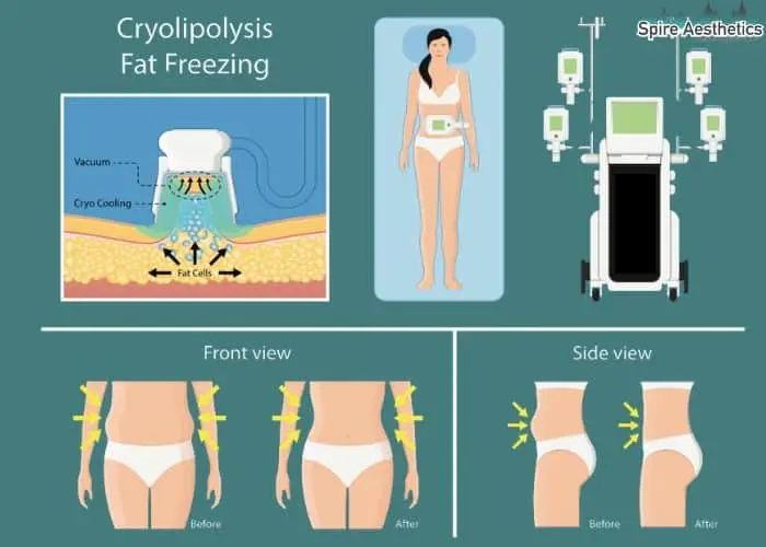 Fat freezing treatment Wibsey benefits for competitions to remove stubborn fat deposits.
