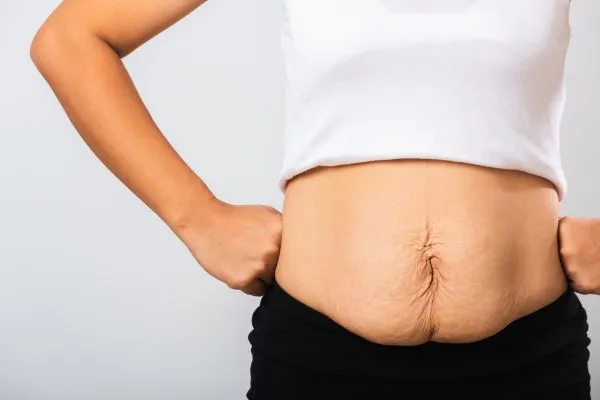 Image of a woman's stomach after weight loss with sagging skin following a gastric band Wibsey